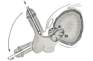 Diagram of endoscopic penis enlargement surgery