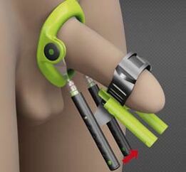 Rehabilitation after an activity to increase the penis