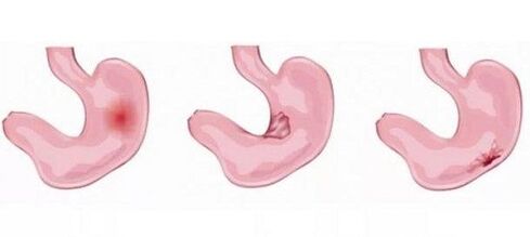 Stomach problems as a contraindication to penis enlargement by soda